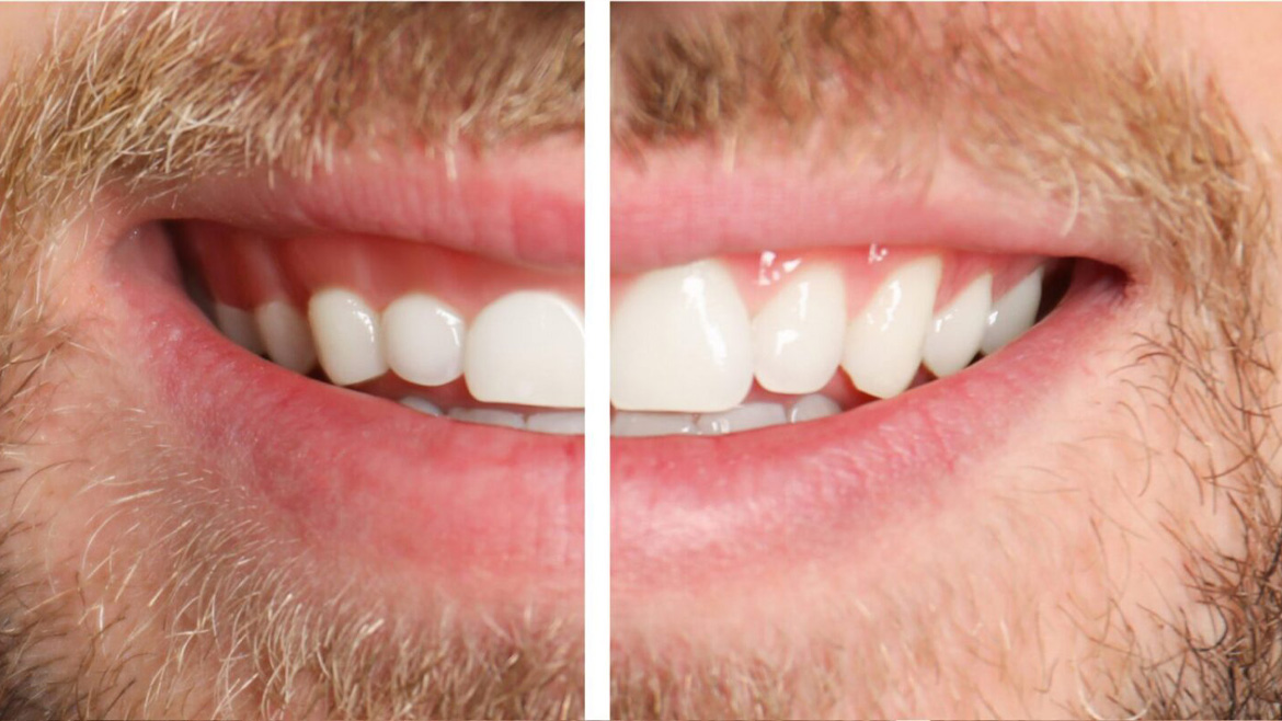 Gum Contouring