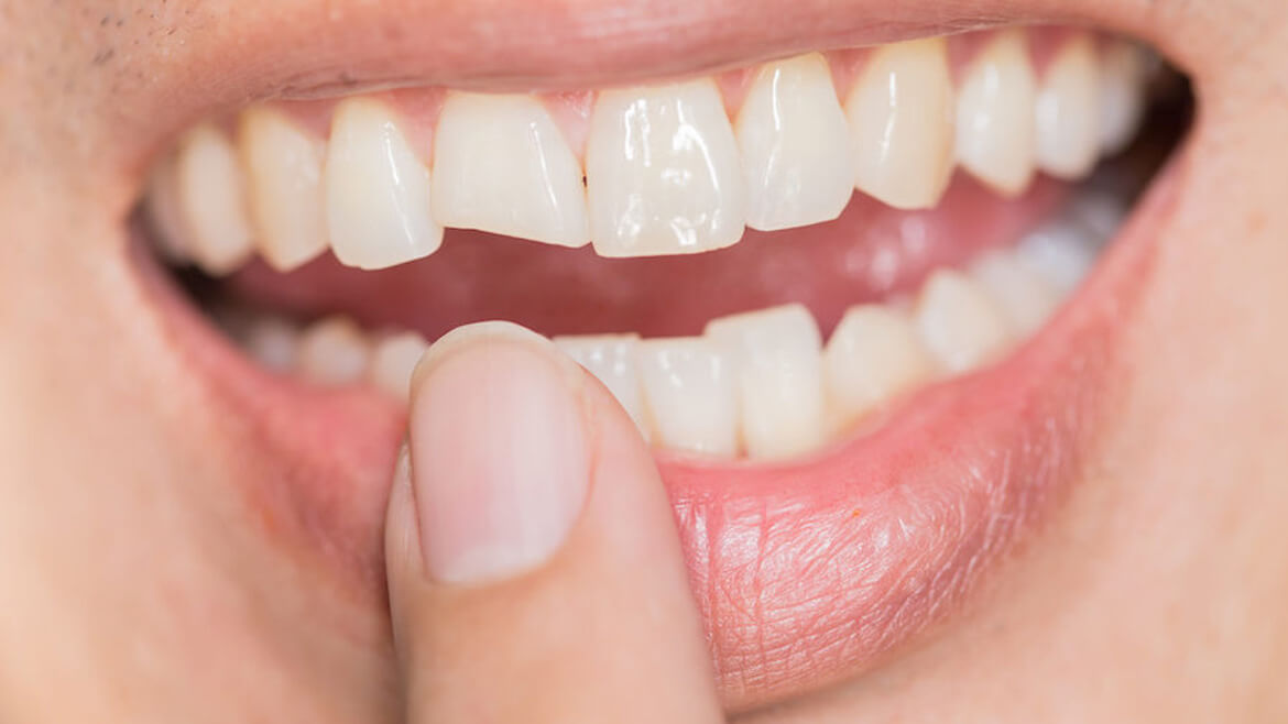 Broken or Chipped Teeth