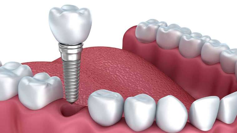 Implants