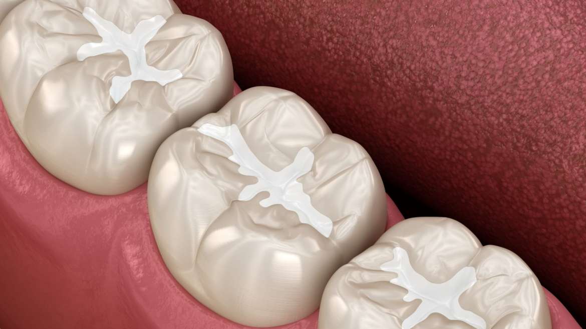 Sealants