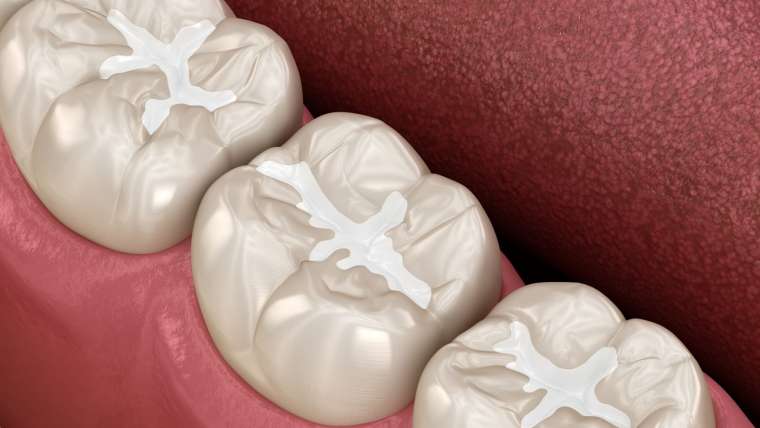Sealants