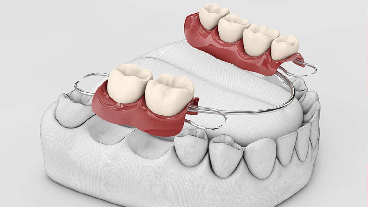 Dentures