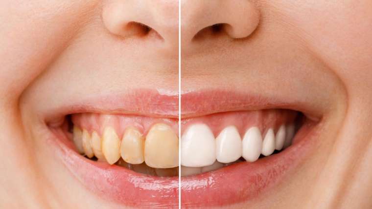 Veneers