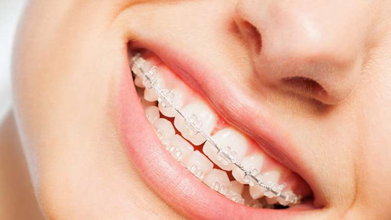 Braces