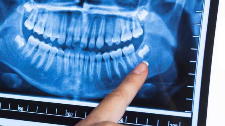 Wisdom Teeth Removal