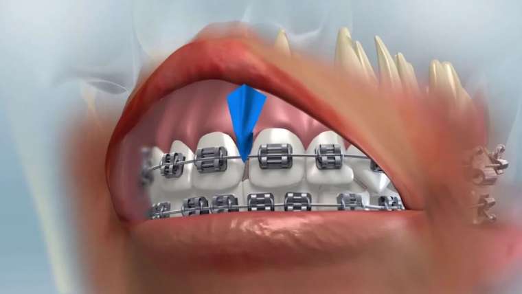 Frenectomy