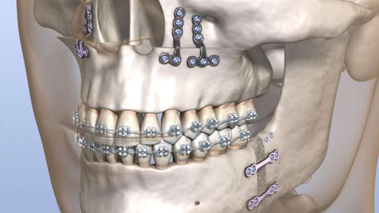 Jaw Surgery (Orthognathic Surgery)