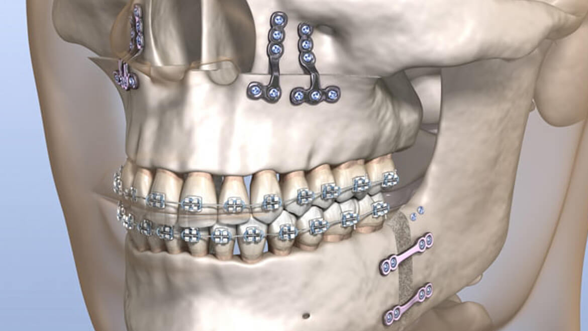 Jaw Surgery (Orthognathic Surgery)