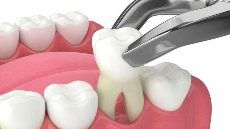 Tooth Extractions